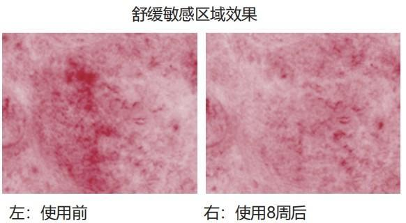 皮肤过敏水平改善(文档原图):使用含10% RiceFerm 产品后 SCORAD 过敏评分随时间下降